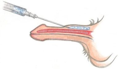 Injection of polymer materials into the penis in order to thicken it