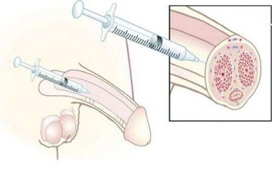 Injection of hyaluronic acid injections