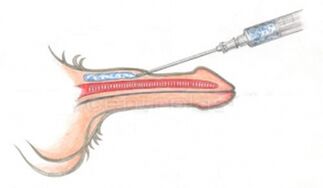 Volumizing hyaluronic acid injection into the penis